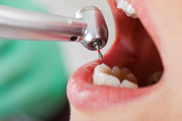 Best Emergency Tooth Extraction in Broomall, PA